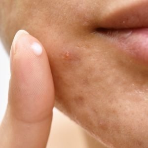 Topical Clascoterone for Acne image
