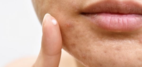 Topical Clascoterone for Acne image