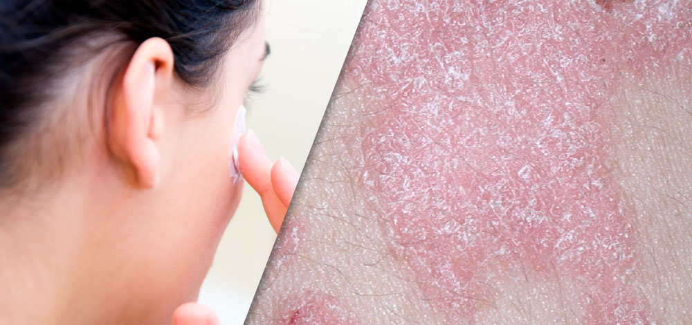 The Evolution of Topical Formulations in Psoriasis