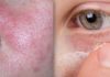 An Update on the Role of Topical Metronidazole in Rosacea