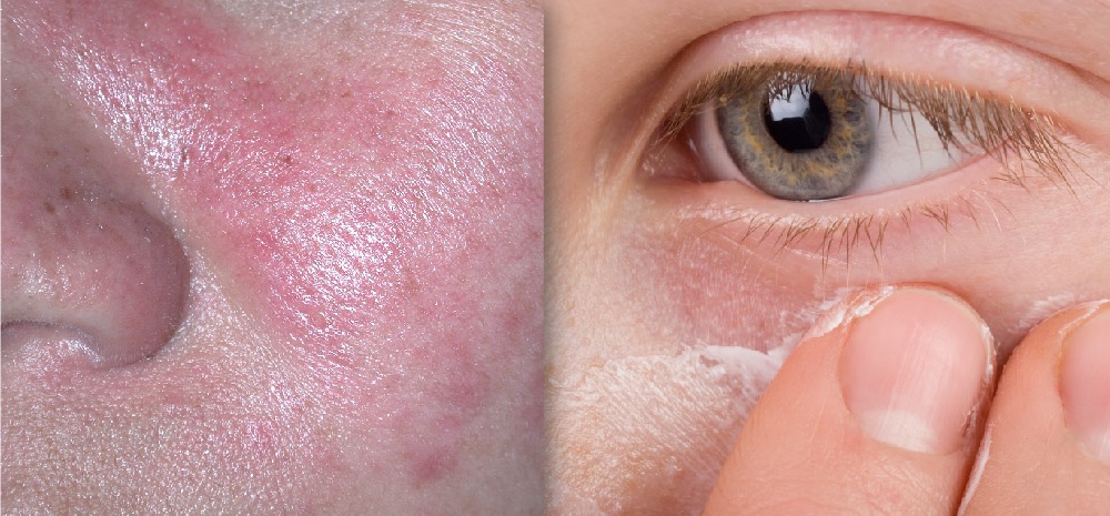An Update on the Role of Topical Metronidazole in Rosacea
