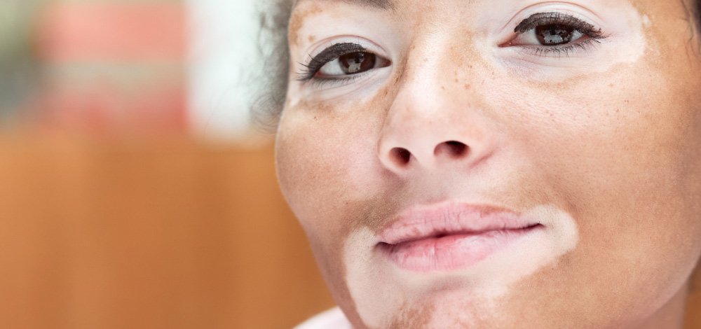 African-American woman with vitiligo closeup, smiling