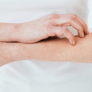 a crop up image of woman scratching her dry skin (Tralokinumab)