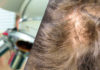 Treating and Preventing Androgenic Alopecia