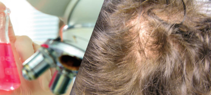 Treating and Preventing Androgenic Alopecia