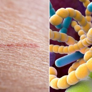 PDF: A Review of the Role and Treatment of Biofilms in Skin Disorders