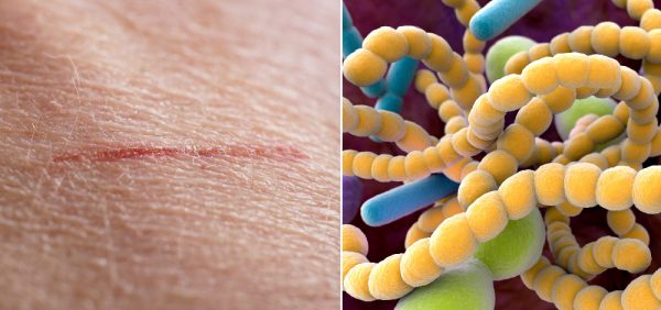 PDF: A Review of the Role and Treatment of Biofilms in Skin Disorders