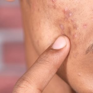 male acne patient face closeup