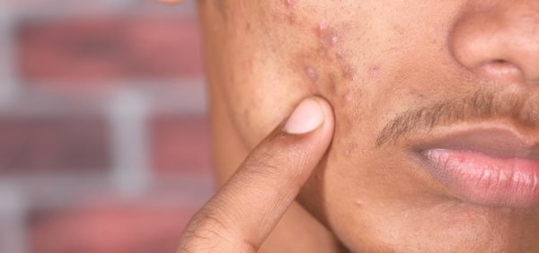 male acne patient face closeup