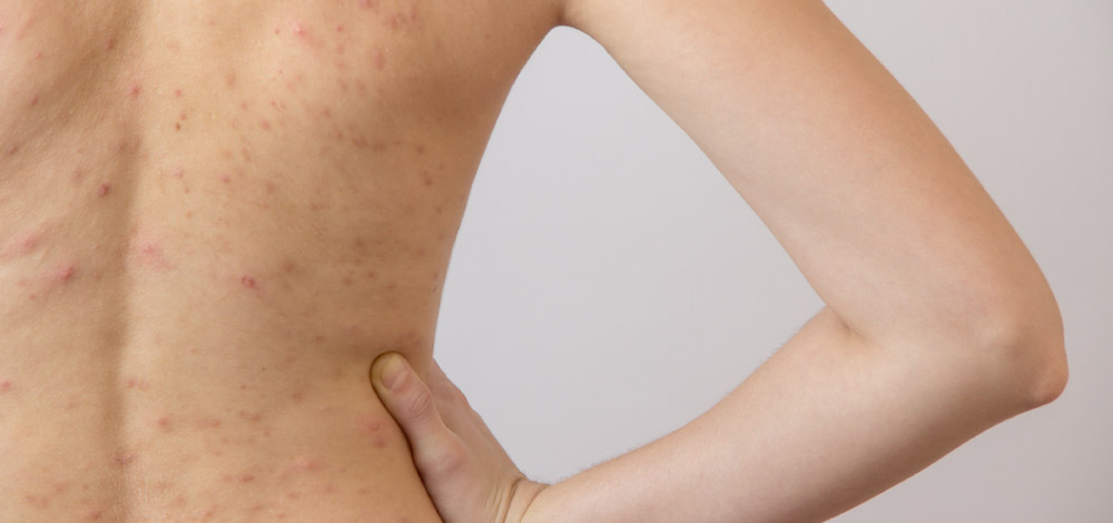 Understanding Truncal Acne: A Practical Guide to Diagnosis and Management