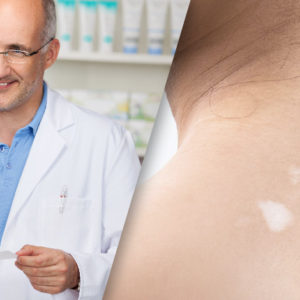 Management Vitiligo