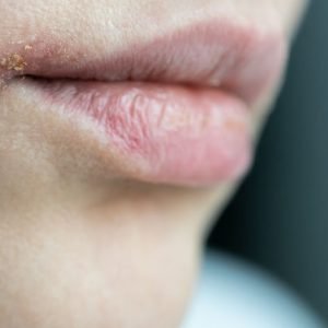 image of woman with infected lips, cold sore