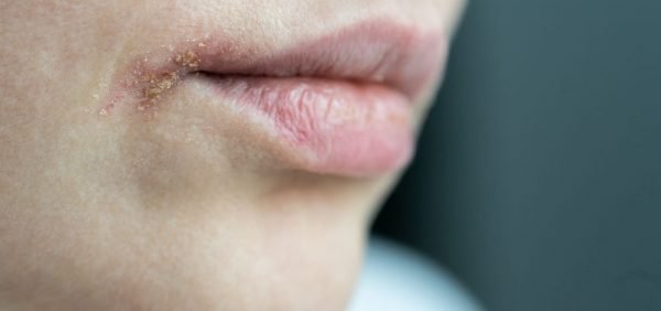 image of woman with infected lips, cold sore