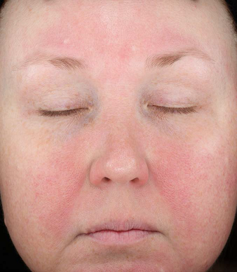 Rosacea: An Update on Medical Therapies (Family Practice) - image