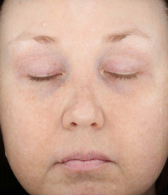 Rosacea: An Update on Medical Therapies (Family Practice) - image