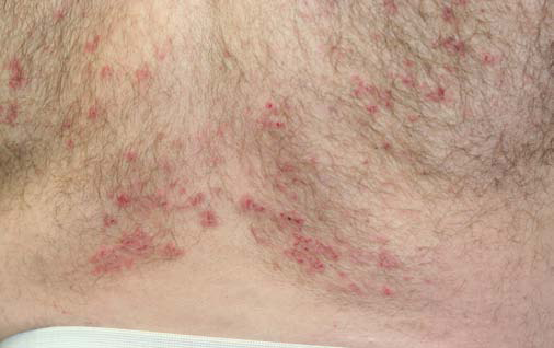 Dermatitis Herpetiformis - image