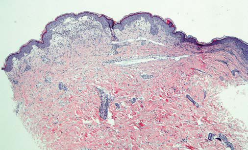 Dermatitis Herpetiformis - image