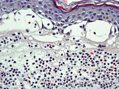 Dermatitis Herpetiformis - image