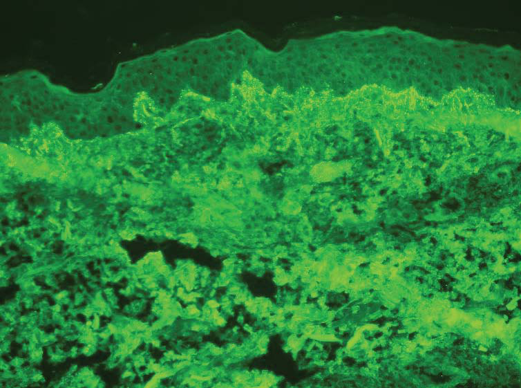 Dermatitis Herpetiformis - image