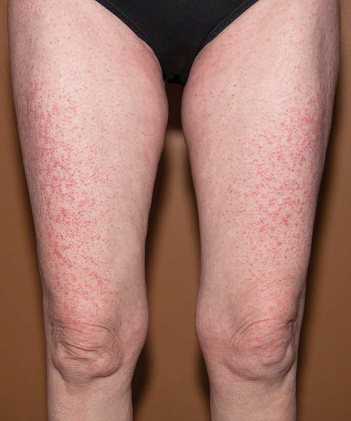 Metastatic Melanoma: Optimizing Outcomes by Managing Dermatologic Toxicities Associated with Novel Therapies - image