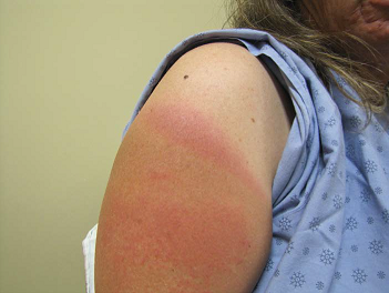 Metastatic Melanoma: Optimizing Outcomes by Managing Dermatologic Toxicities Associated with Novel Therapies - image