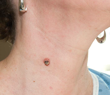 Metastatic Melanoma: Optimizing Outcomes by Managing Dermatologic Toxicities Associated with Novel Therapies - image