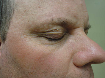 Metastatic Melanoma: Optimizing Outcomes by Managing Dermatologic Toxicities Associated with Novel Therapies - image