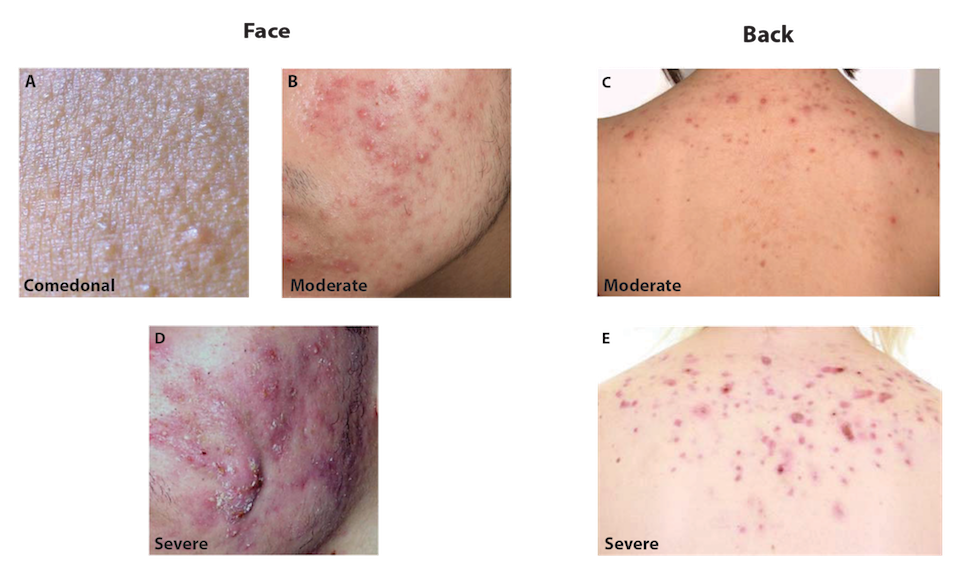 Representative photos of acne categories. 