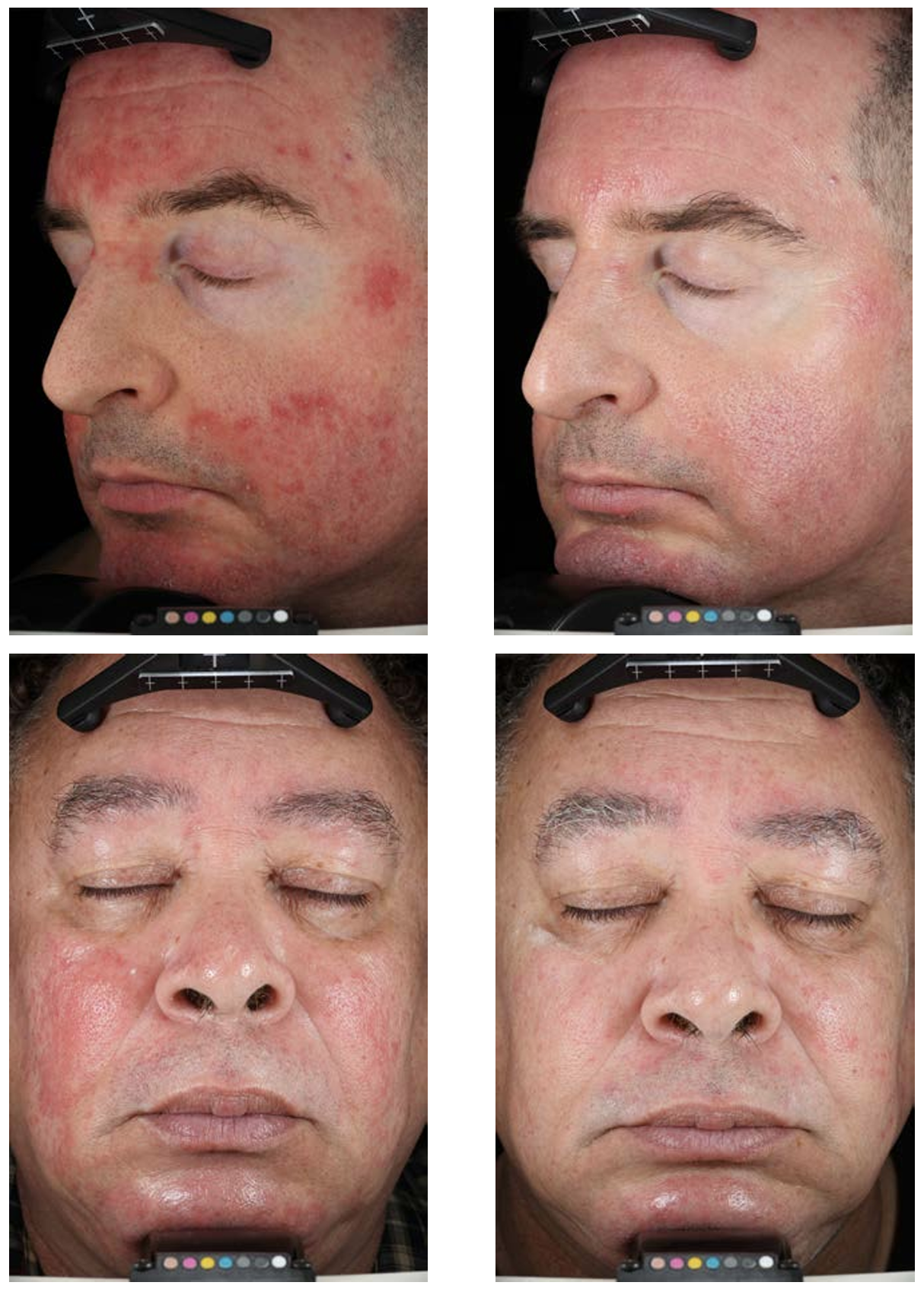 Real-World Efficacy of Azelaic Acid 15% Gel for the Reduction of Inflammatory Lesions of Rosacea - image