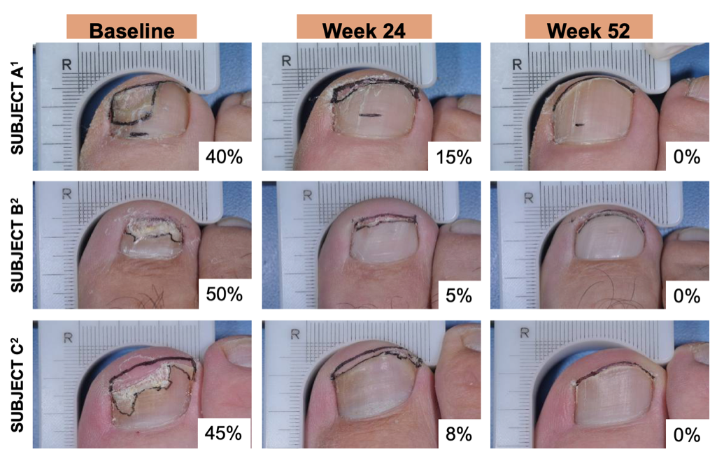 Efinaconazole in the Treatment of Onychomycosis: Managing Patient Expectations and Promoting Compliance - image