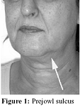 Figure 1: Prejowl sulcus