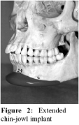 Figure 2: Extended chin-jowl implant