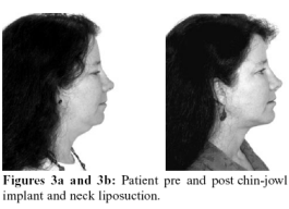 Figures 3a and 3b: Patient pre- and postchin-jowl implant and neck liposuction.