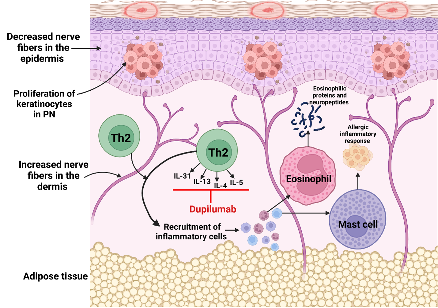 Dupilumab for the Treatment of Prurigo Nodularis - image