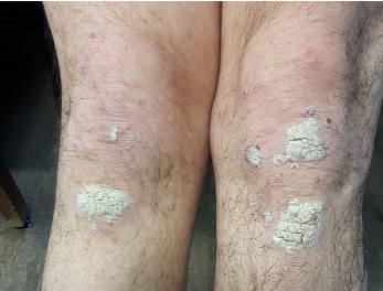 Understanding Psoriasis: Insights from Les Journées Dermatologiques de Paris - image